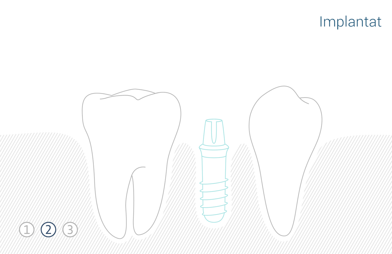 Zahnimplantat 1 2