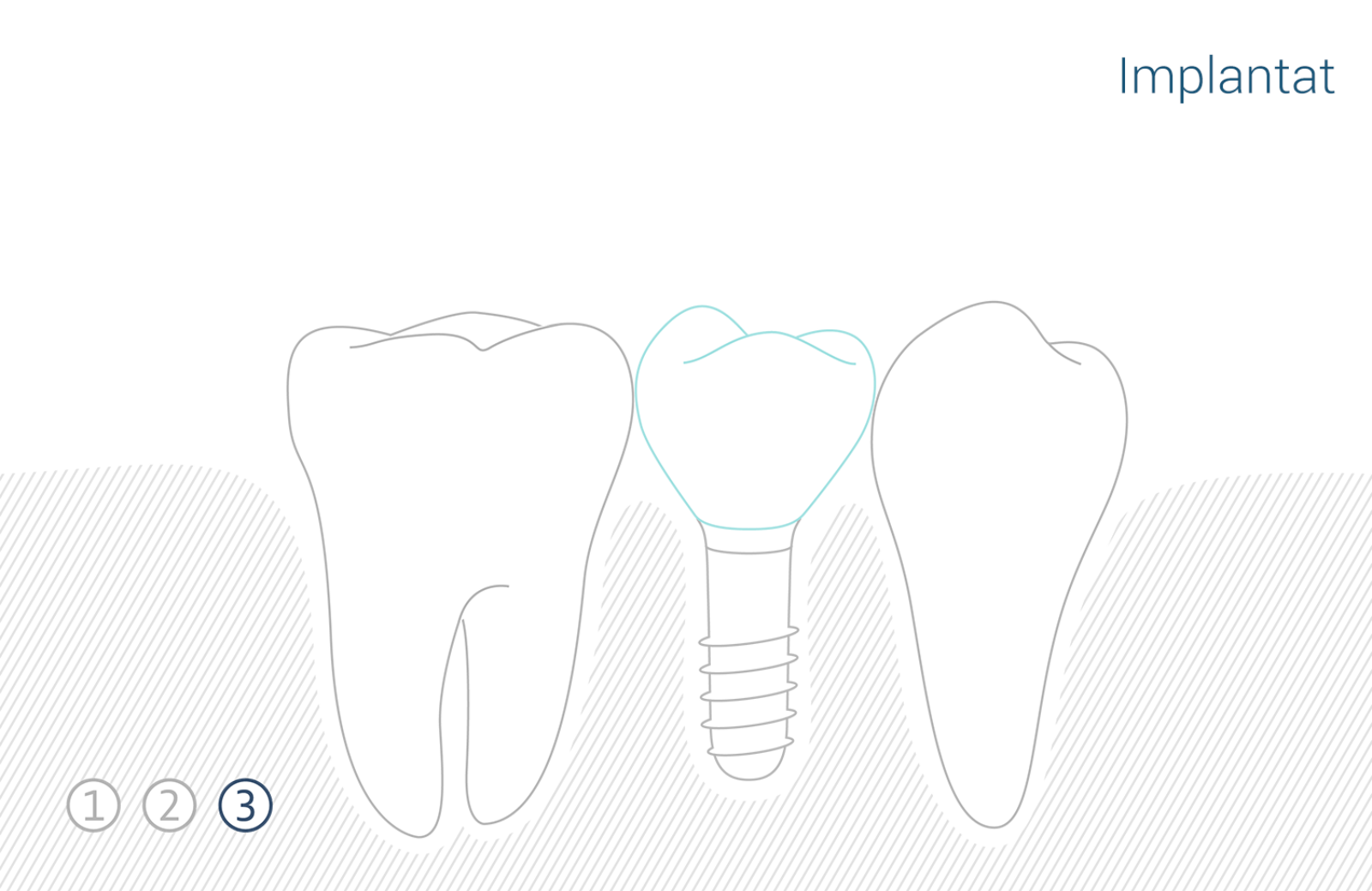 Zahnimplantat 1 3
