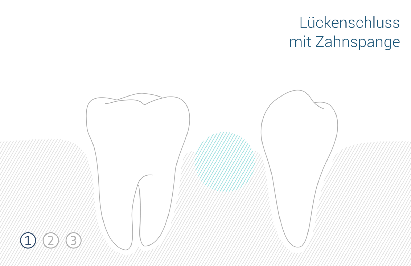 Zahnmedizin lueckenschluss 1 1